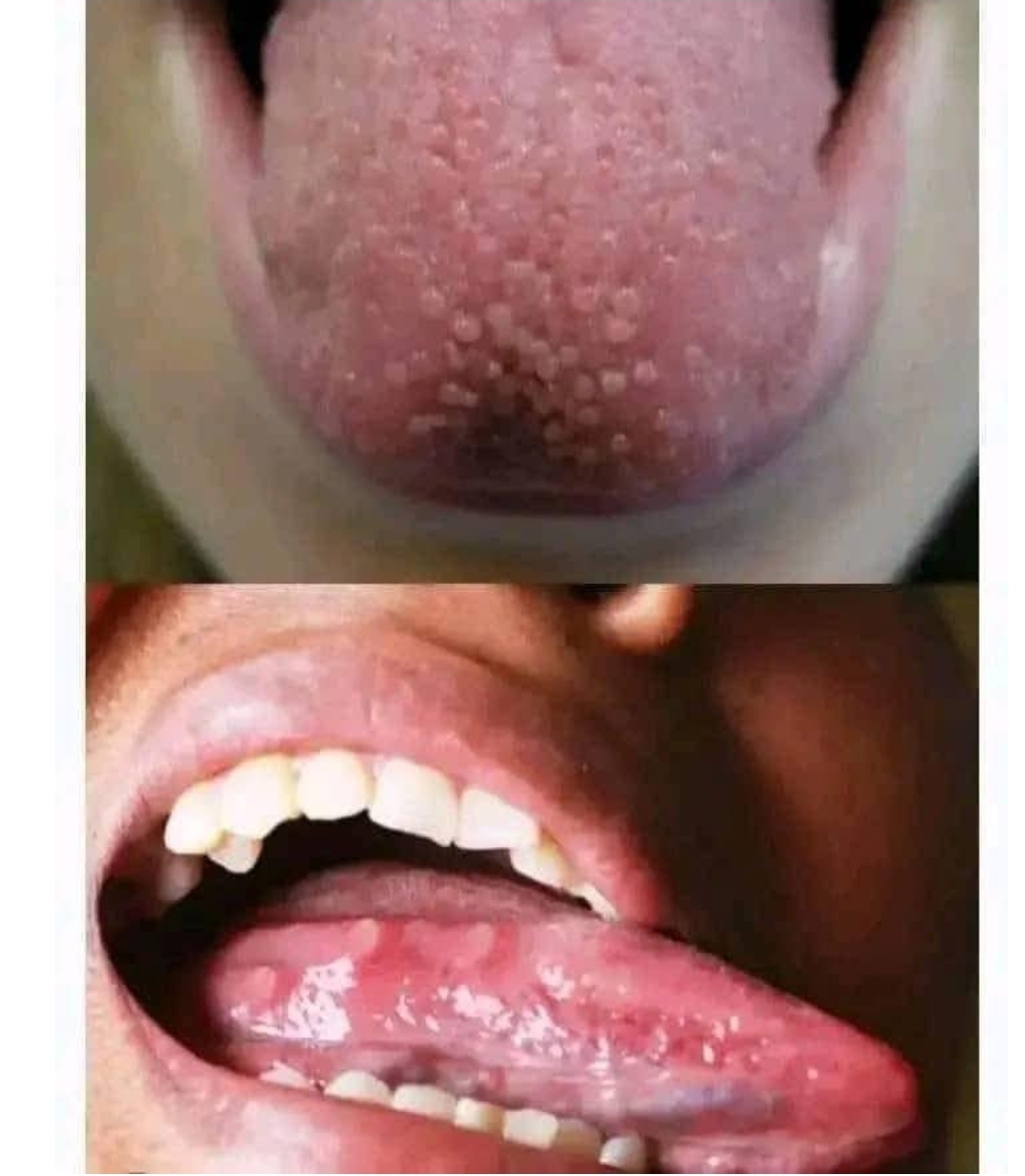 If you have pimples on your tongue, your body is warning you about something very important